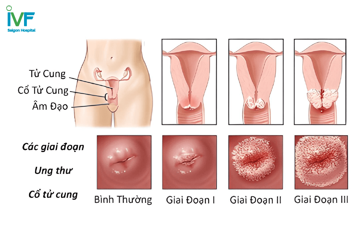 Ung thư cổ tử cung