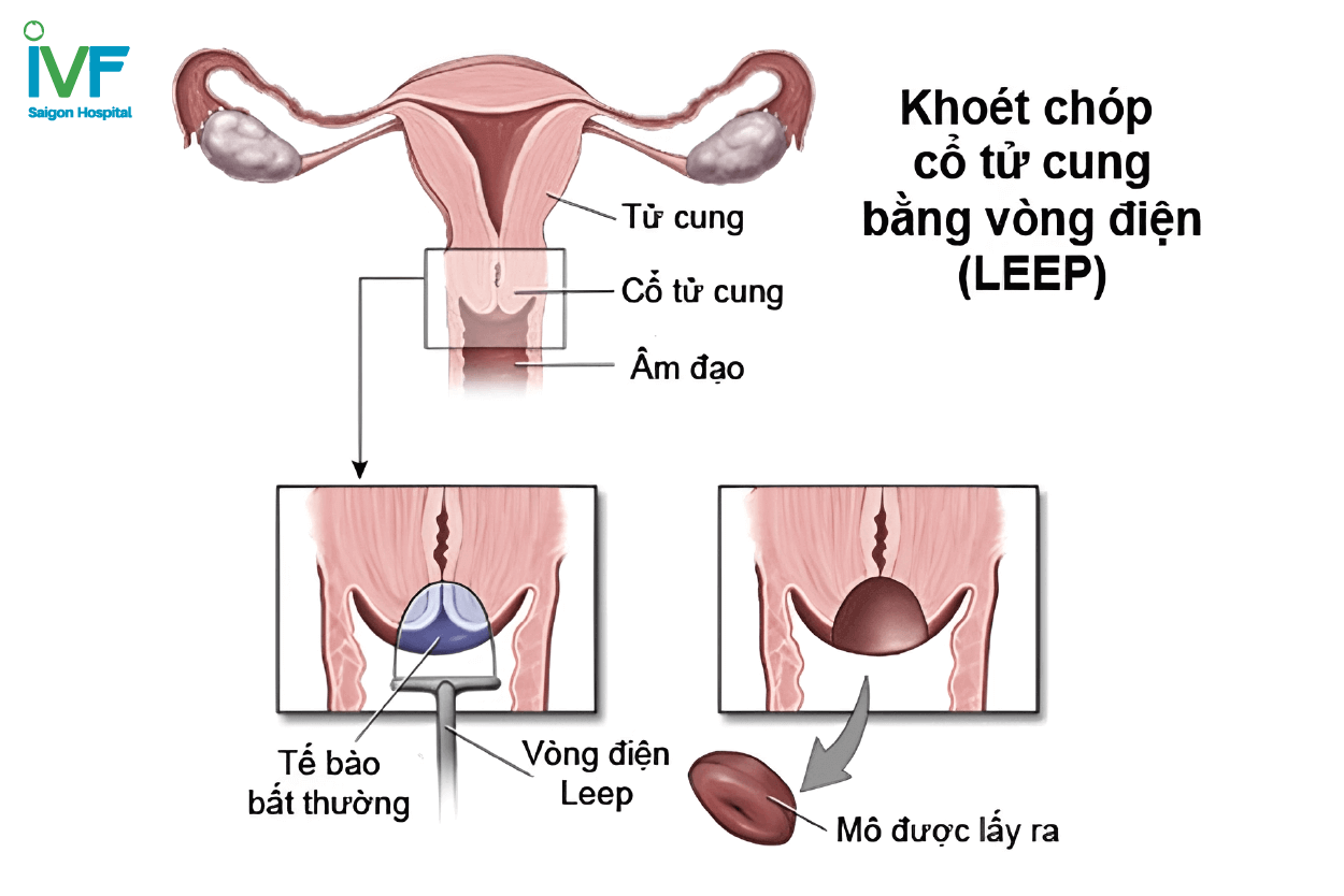 Khoét chóp cổ tử cung