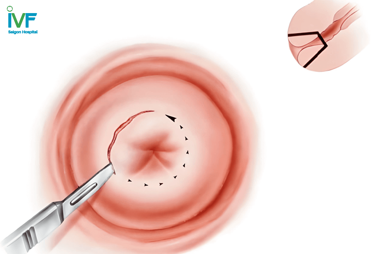 Khoét chóp cổ tử cung
