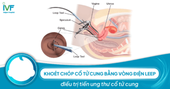 Khoét chóp cổ tử cung bằng vòng điện LEEP điều trị tiền ung thư cổ tử cung