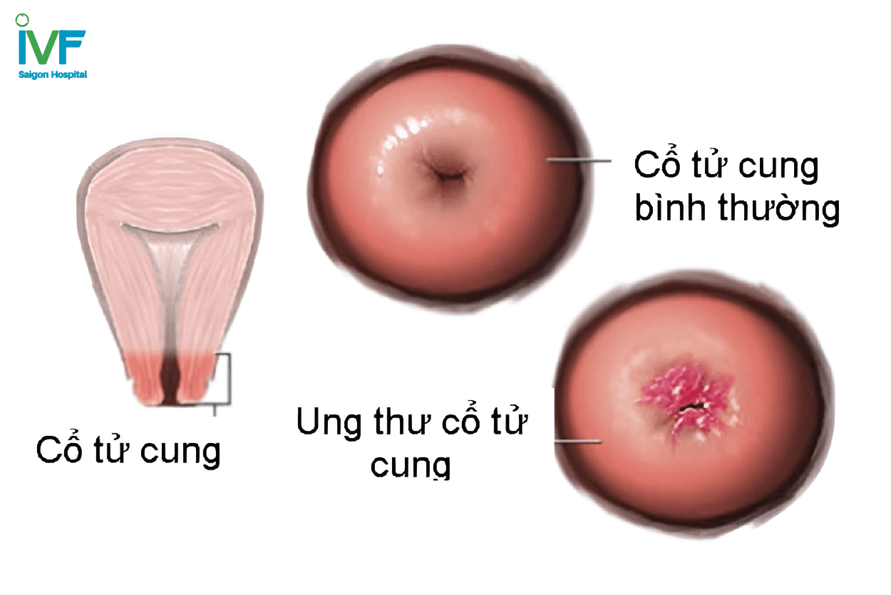 Khoét chóp cổ tử cung