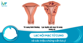 Lạc nội mạc tử cung và các triệu chứng cần lưu ý