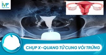 Chụp X-quang tử cung vòi trứng thế nào ở phụ nữ?