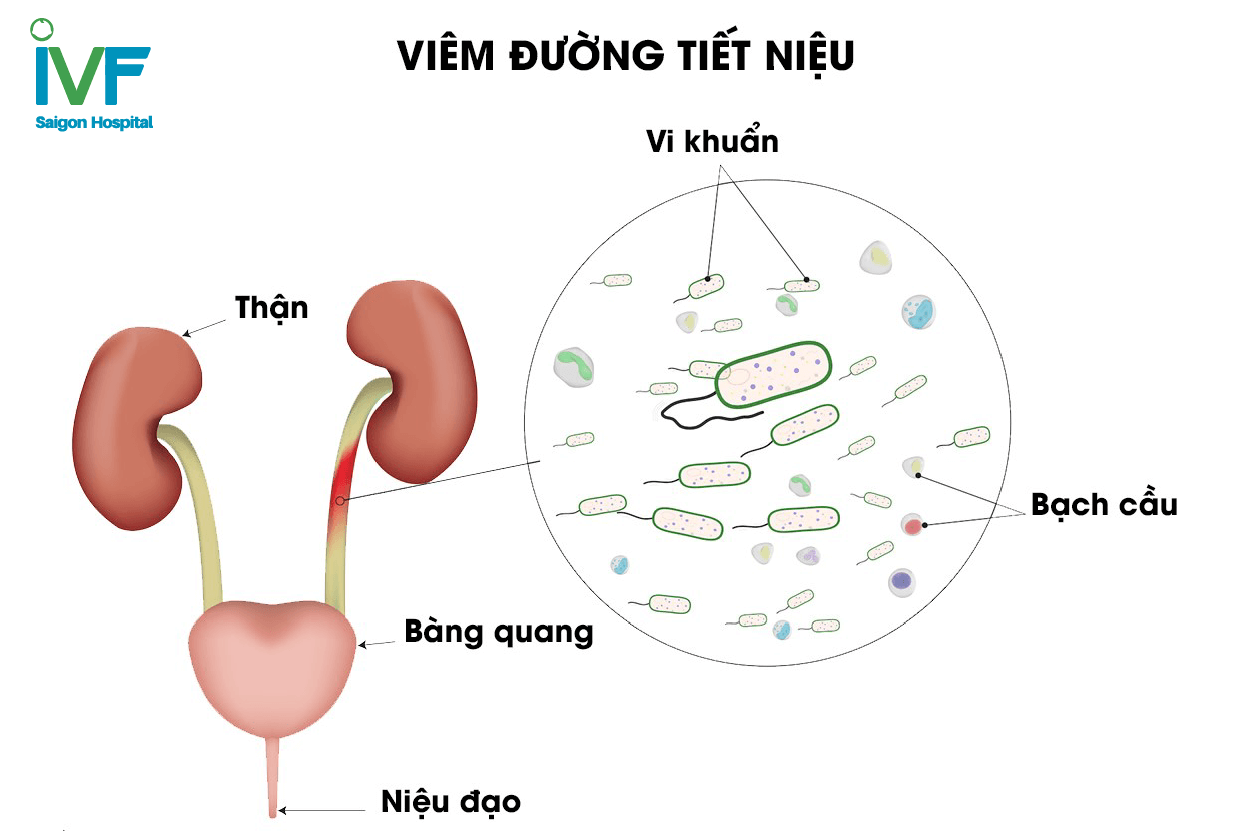 viem-duong-tiet-nieu-la-gi