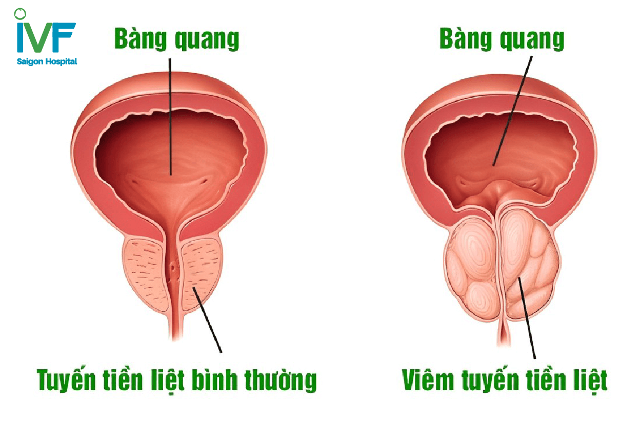 viem-duong-tiet-nieu-nam-gioi