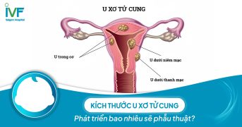 Kích thước u xơ tử cung bao nhiêu sẽ tiến hành phẫu thuật?