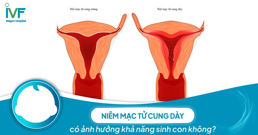 Niêm mạc tử cung dày có ảnh hưởng khả năng sinh con không?