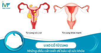 U xơ tử cung: Những điều cần biết để bảo vệ sức khỏe