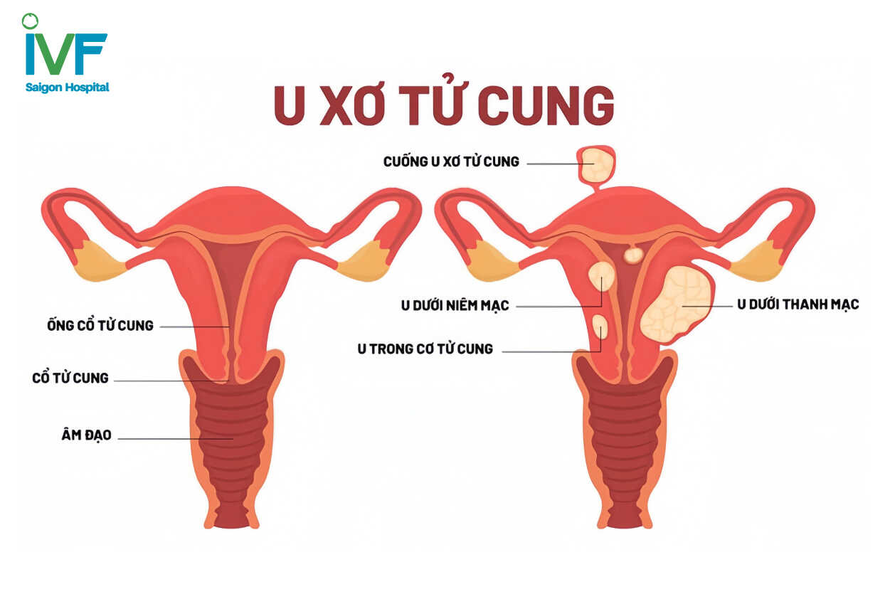 u xo tu cung la gi