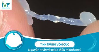 Tinh trùng vón cục: Nguyên nhân và cách điều trị thế nào?