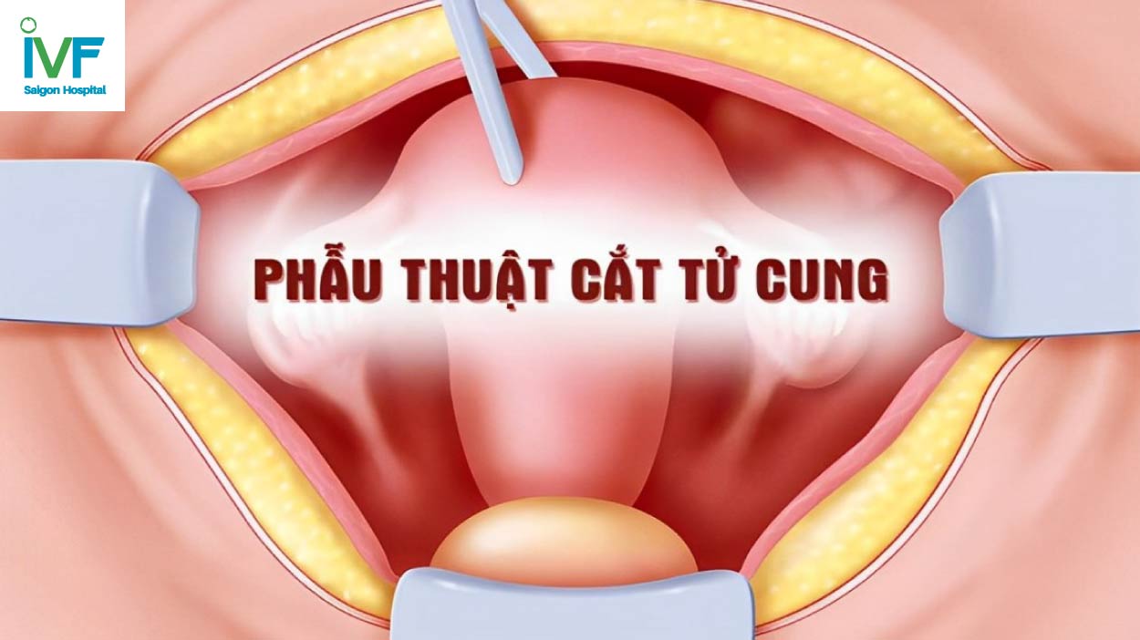 phau thuat cat bo co tu cung