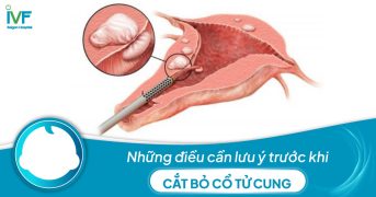 Những điều cần lưu ý trước khi cắt bỏ cổ tử cung