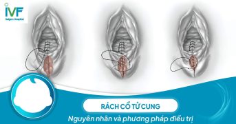 Nguyên nhân và phương pháp điều trị rách cổ tử cung