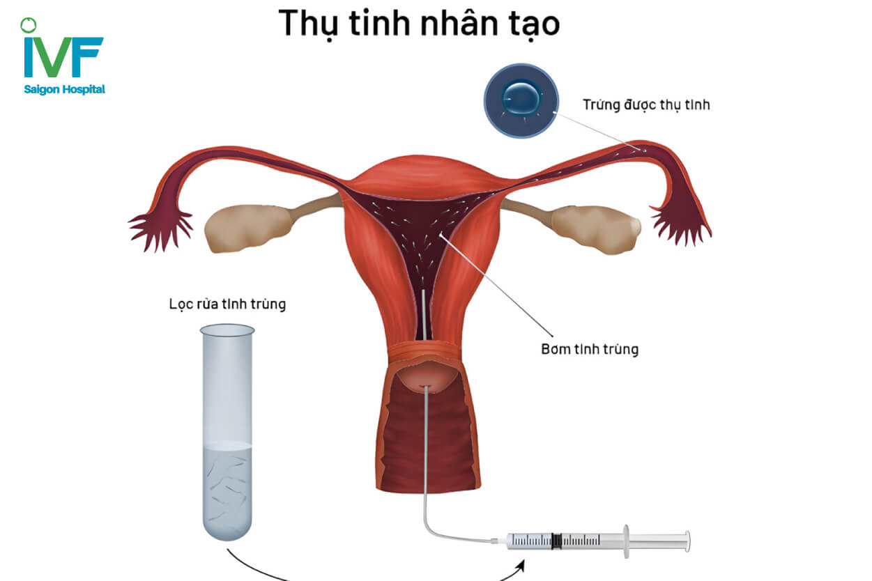 thu tinh nhan tao la gi 