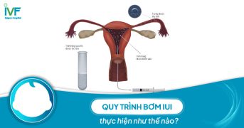 Quy trình bơm IUI thực hiện như thế nào?