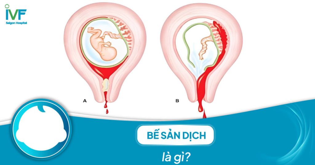 Bế sản dịch là gì? Tìm hiểu nguyên nhân và cách điều trị hiệu quả