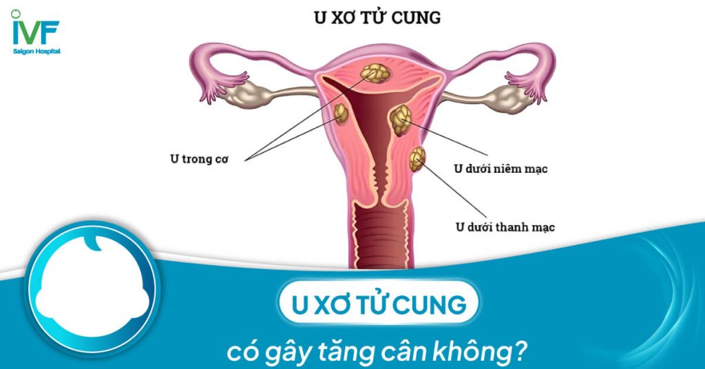 U xơ tử cung có gây tăng cân không?
