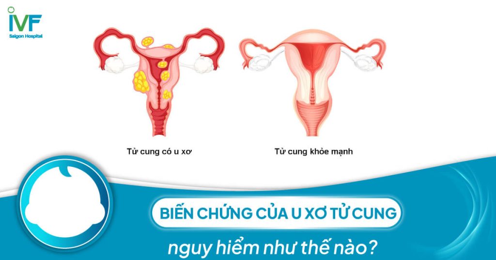 Biến chứng của u xơ tử cung nguy hiểm như thế nào?